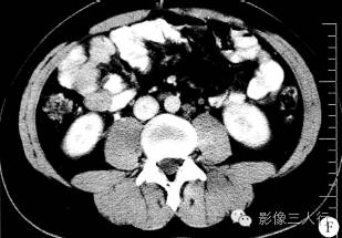【病例】盆腔巨淋巴结增生症1例CT影像表现 【病例】盆腔巨淋巴结增生症1例CT影像表现