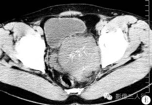 【病例】盆腔巨淋巴结增生症1例CT影像表现 【病例】盆腔巨淋巴结增生症1例CT影像表现
