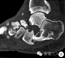 【病例】左足Charcot骨关节病(夏科氏关节)1例CT影像表现 【病例】左足Charcot骨关节病(夏科氏关节)1例CT影像表现