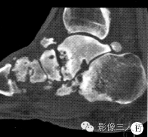 【病例】左足Charcot骨关节病(夏科氏关节)1例CT影像表现 【病例】左足Charcot骨关节病(夏科氏关节)1例CT影像表现