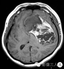 【病例】脑实质内巨大胆脂瘤1例MR影像表现