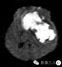 【病例】脑实质内巨大胆脂瘤1例MR影像表现 【病例】脑实质内巨大胆脂瘤1例MR影像表现