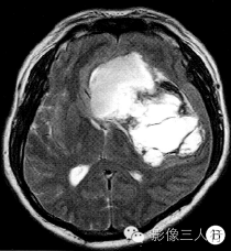 【病例】脑实质内巨大胆脂瘤1例MR影像表现 【病例】脑实质内巨大胆脂瘤1例MR影像表现