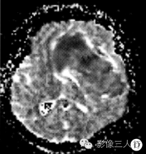 【病例】脑实质内巨大胆脂瘤1例MR影像表现 【病例】脑实质内巨大胆脂瘤1例MR影像表现