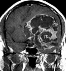 【病例】脑实质内巨大胆脂瘤1例MR影像表现 【病例】脑实质内巨大胆脂瘤1例MR影像表现