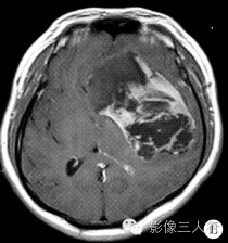 【病例】脑实质内巨大胆脂瘤1例MR影像表现 【病例】脑实质内巨大胆脂瘤1例MR影像表现