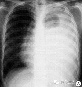 【病例】胸腔Askin瘤1例影像表现