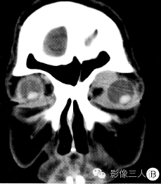 【病例】眼眶不典型血管瘤1例CT及MR影像表现 【病例】眼眶不典型血管瘤1例CT及MR影像表现