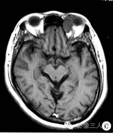 【病例】眼眶不典型血管瘤1例CT及MR影像表现 【病例】眼眶不典型血管瘤1例CT及MR影像表现