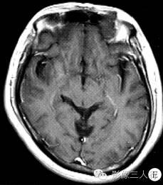 【病例】眼眶不典型血管瘤1例CT及MR影像表现 【病例】眼眶不典型血管瘤1例CT及MR影像表现