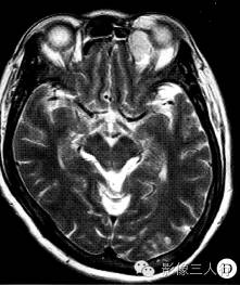 【病例】眼眶不典型血管瘤1例CT及MR影像表现 【病例】眼眶不典型血管瘤1例CT及MR影像表现