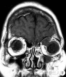 【病例】眼眶不典型血管瘤1例CT及MR影像表现 【病例】眼眶不典型血管瘤1例CT及MR影像表现