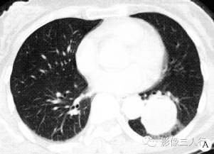 【病例】左下肺硬化性血管瘤1例CT影像表现 【病例】左下肺硬化性血管瘤1例CT影像表现