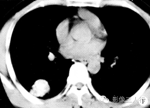 【病例】左下肺硬化性血管瘤1例CT影像表现 【病例】左下肺硬化性血管瘤1例CT影像表现