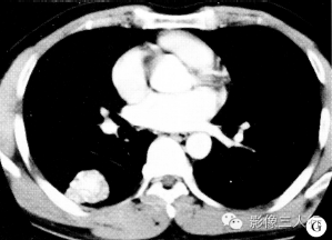 【病例】左下肺硬化性血管瘤1例CT影像表现 【病例】左下肺硬化性血管瘤1例CT影像表现
