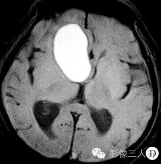 【病例】鞍上颅咽管瘤1例MR影像表现 【病例】鞍上颅咽管瘤1例MR影像表现