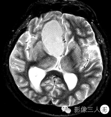 【病例】鞍上颅咽管瘤1例MR影像表现 【病例】鞍上颅咽管瘤1例MR影像表现