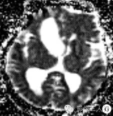 【病例】鞍上颅咽管瘤1例MR影像表现 【病例】鞍上颅咽管瘤1例MR影像表现