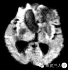 【病例】鞍上颅咽管瘤1例MR影像表现 【病例】鞍上颅咽管瘤1例MR影像表现