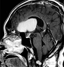 【病例】鞍上颅咽管瘤1例MR影像表现 【病例】鞍上颅咽管瘤1例MR影像表现