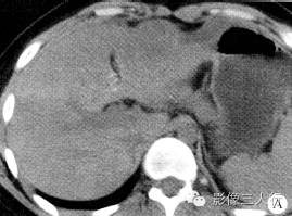 【病例】肝包膜下及后腹膜结核瘤1例CT影像表现