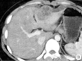 【病例】肝包膜下及后腹膜结核瘤1例CT影像表现 【病例】肝包膜下及后腹膜结核瘤1例CT影像表现