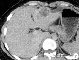【病例】肝包膜下及后腹膜结核瘤1例CT影像表现 【病例】肝包膜下及后腹膜结核瘤1例CT影像表现