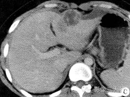 【病例】肝包膜下及后腹膜结核瘤1例CT影像表现 【病例】肝包膜下及后腹膜结核瘤1例CT影像表现