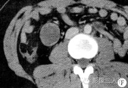 【病例】肝包膜下及后腹膜结核瘤1例CT影像表现 【病例】肝包膜下及后腹膜结核瘤1例CT影像表现