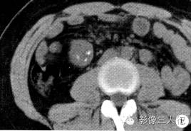 【病例】肝包膜下及后腹膜结核瘤1例CT影像表现 【病例】肝包膜下及后腹膜结核瘤1例CT影像表现