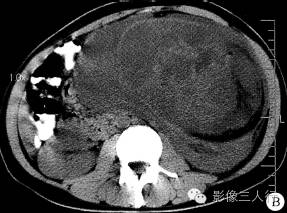 【病例】腹膜后黏液型脂肪肉瘤1例CT影像表现 【病例】腹膜后黏液型脂肪肉瘤1例CT影像表现