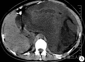 【病例】腹膜后黏液型脂肪肉瘤1例CT影像表现