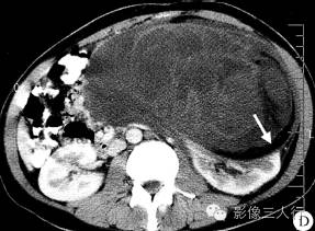 【病例】腹膜后黏液型脂肪肉瘤1例CT影像表现 【病例】腹膜后黏液型脂肪肉瘤1例CT影像表现