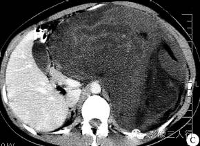 【病例】腹膜后黏液型脂肪肉瘤1例CT影像表现 【病例】腹膜后黏液型脂肪肉瘤1例CT影像表现