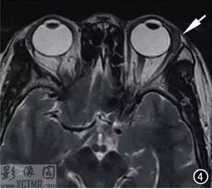 【病例】左侧泪腺区结节病1例CT及MR影像表现 【病例】左侧泪腺区结节病1例CT及MR影像表现