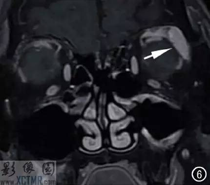 【病例】左侧泪腺区结节病1例CT及MR影像表现 【病例】左侧泪腺区结节病1例CT及MR影像表现