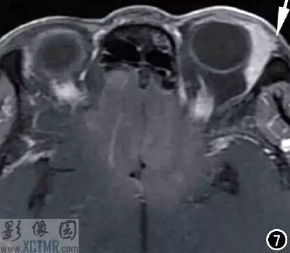 【病例】左侧泪腺区结节病1例CT及MR影像表现 【病例】左侧泪腺区结节病1例CT及MR影像表现