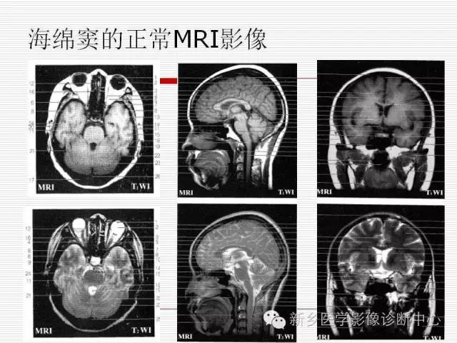 【PPT】引起海绵窦综合征的11种疾病