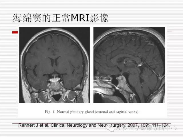 【PPT】引起海绵窦综合征的11种疾病