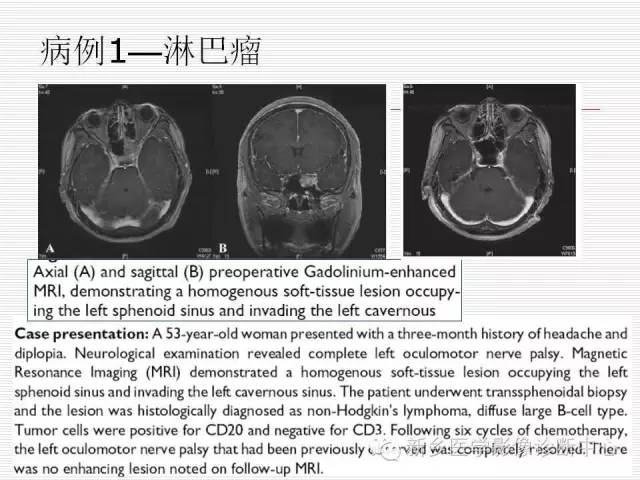 【PPT】引起海绵窦综合征的11种疾病