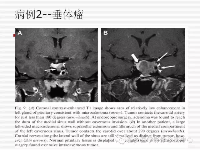 【PPT】引起海绵窦综合征的11种疾病