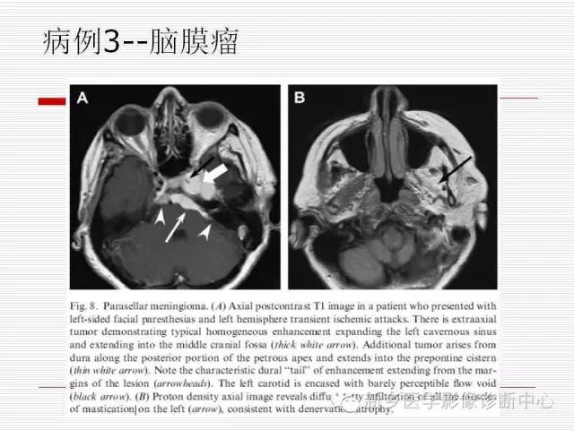 【PPT】引起海绵窦综合征的11种疾病