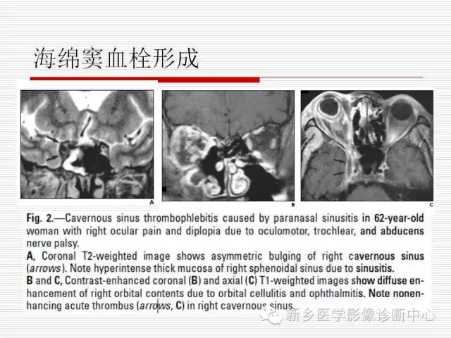 【PPT】引起海绵窦综合征的11种疾病