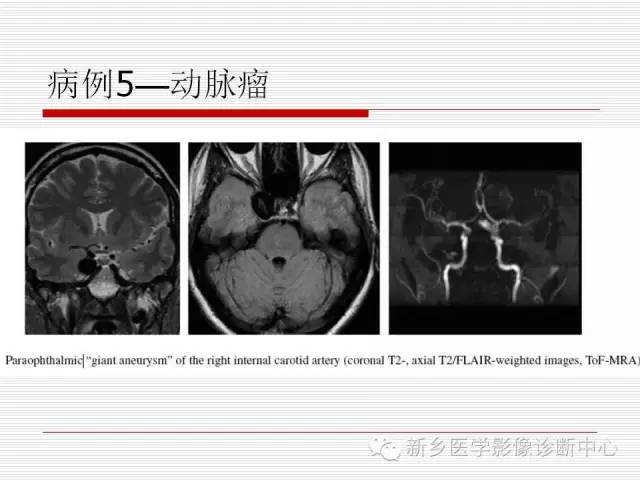 【PPT】引起海绵窦综合征的11种疾病