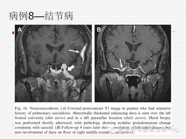【PPT】引起海绵窦综合征的11种疾病