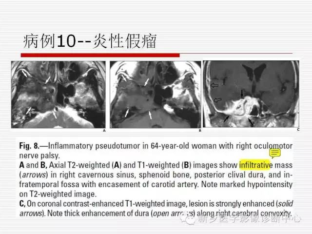 【PPT】引起海绵窦综合征的11种疾病