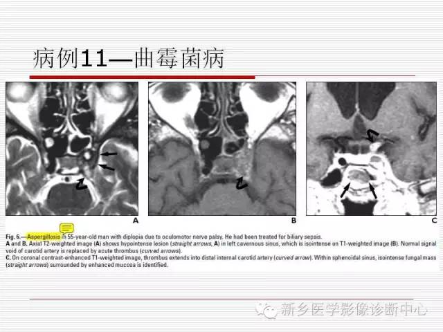 【PPT】引起海绵窦综合征的11种疾病