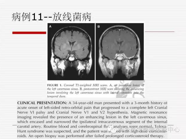 【PPT】引起海绵窦综合征的11种疾病