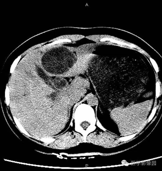 【病例】肝脏囊腺瘤1例CT影像表现 【病例】肝脏囊腺瘤1例CT影像表现