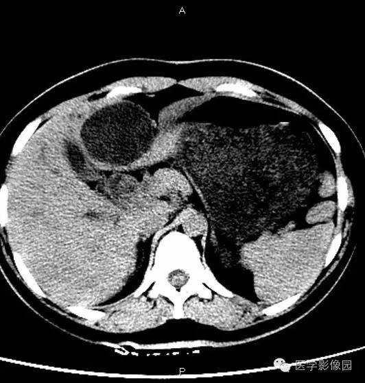 【病例】肝脏囊腺瘤1例CT影像表现 【病例】肝脏囊腺瘤1例CT影像表现